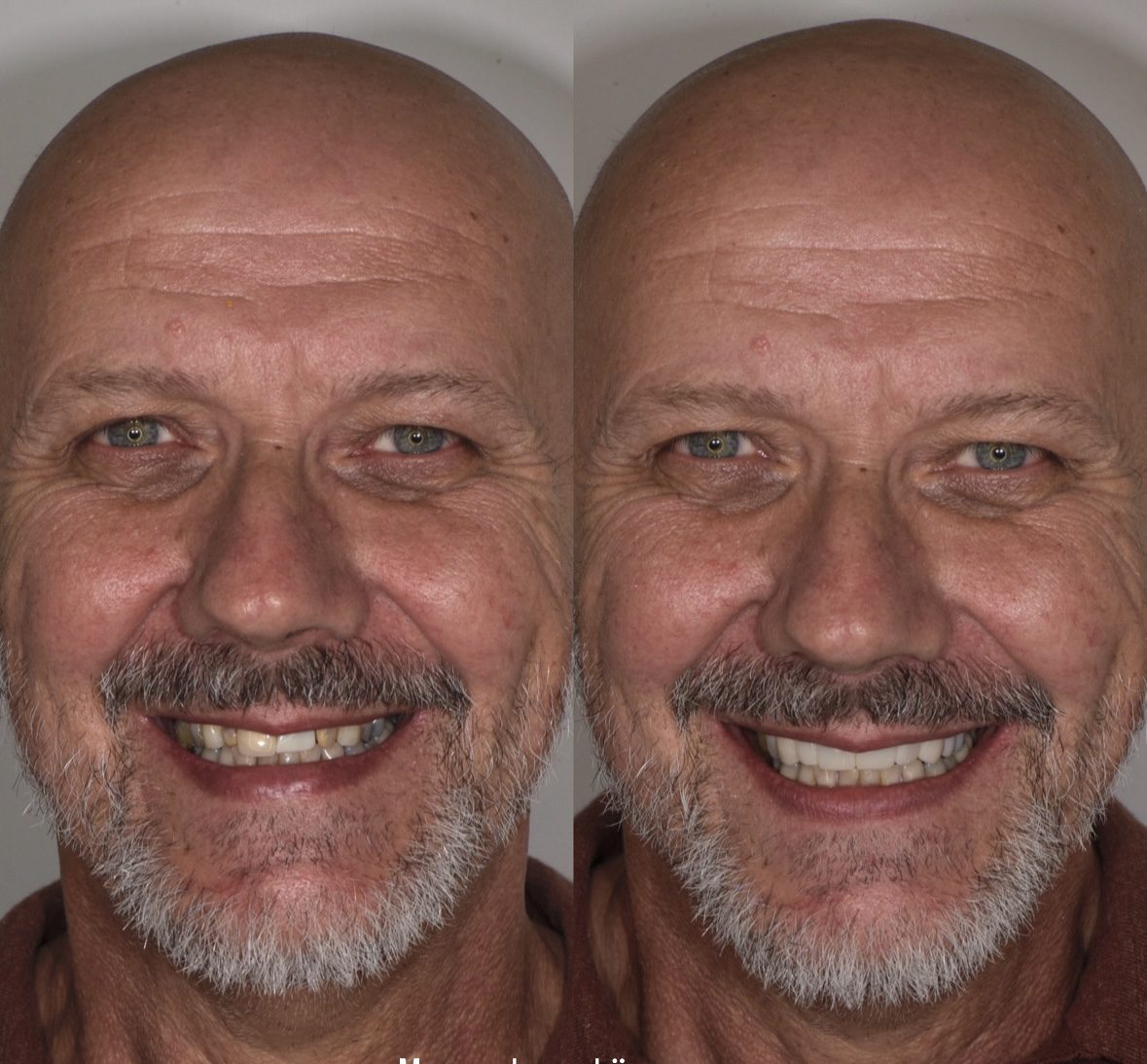 Resultaat tanden bleken | Tandarts Eline