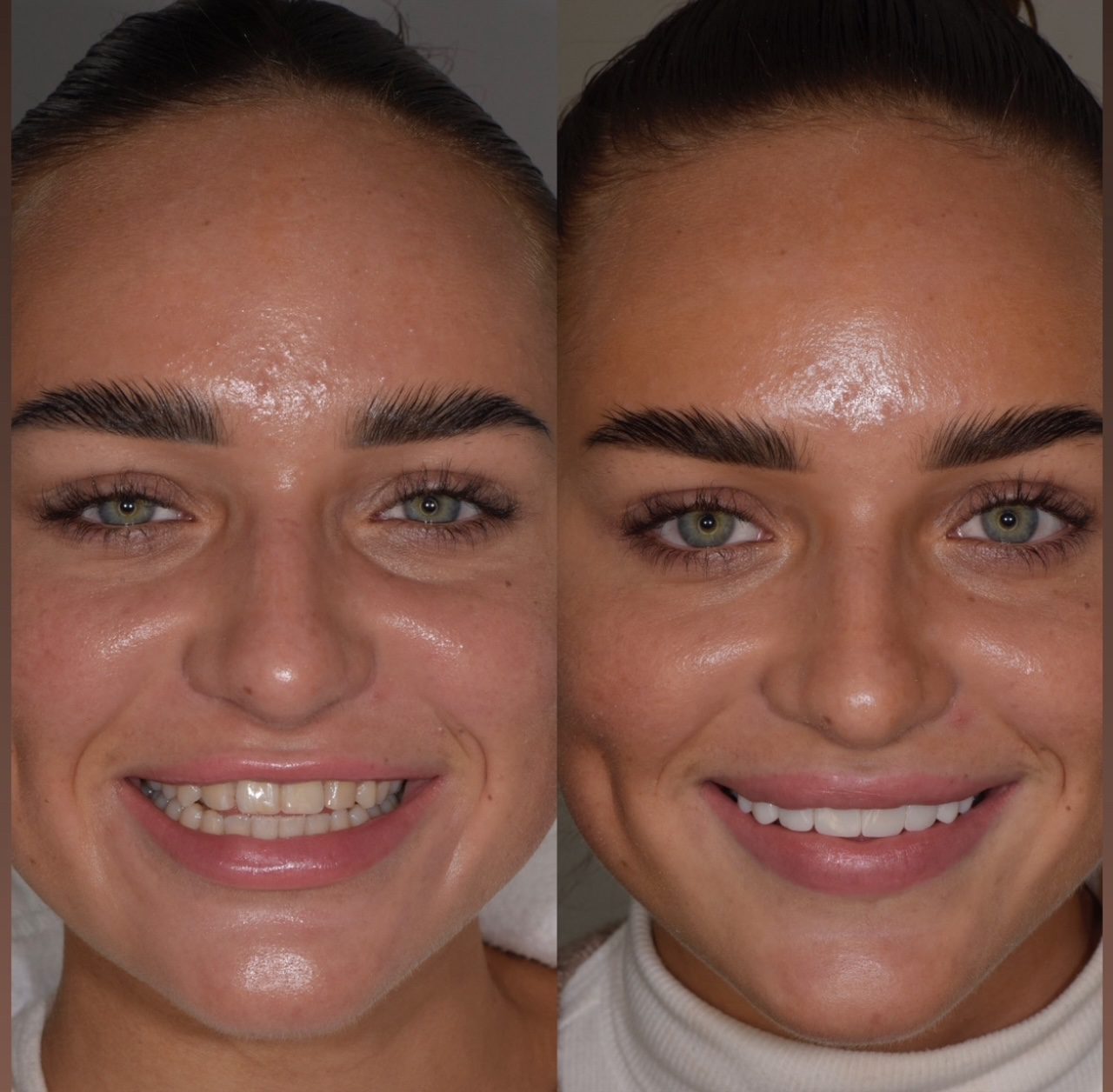 Resultaat tanden bleken | Tandarts Eline