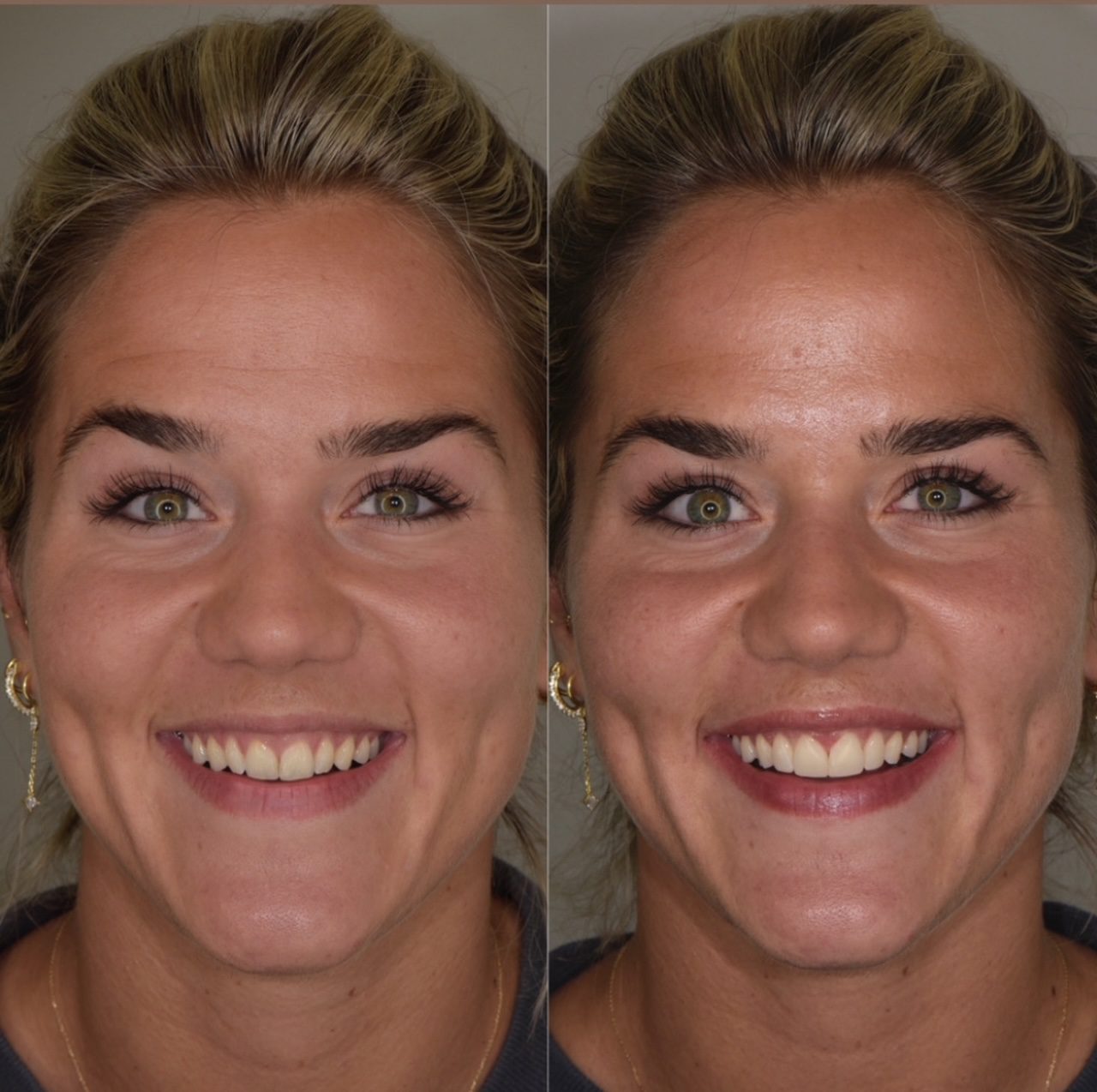 Resultaat tanden bleken | Tandarts Eline