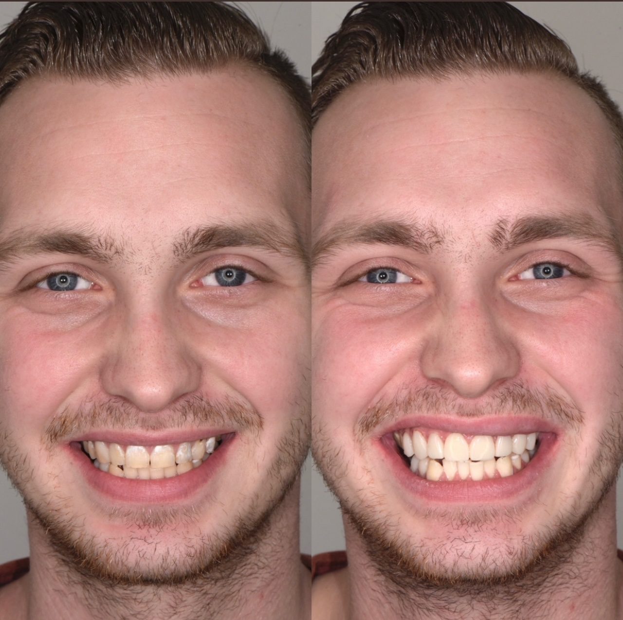 Resultaat tanden bleken | Tandarts Eline
