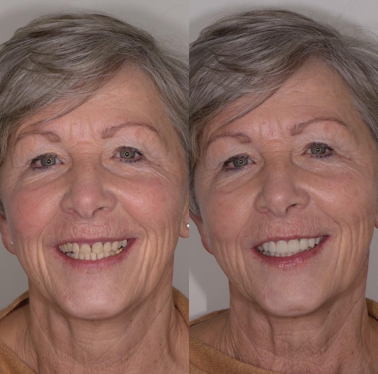 Resultaat tanden bleken | Tandarts Eline