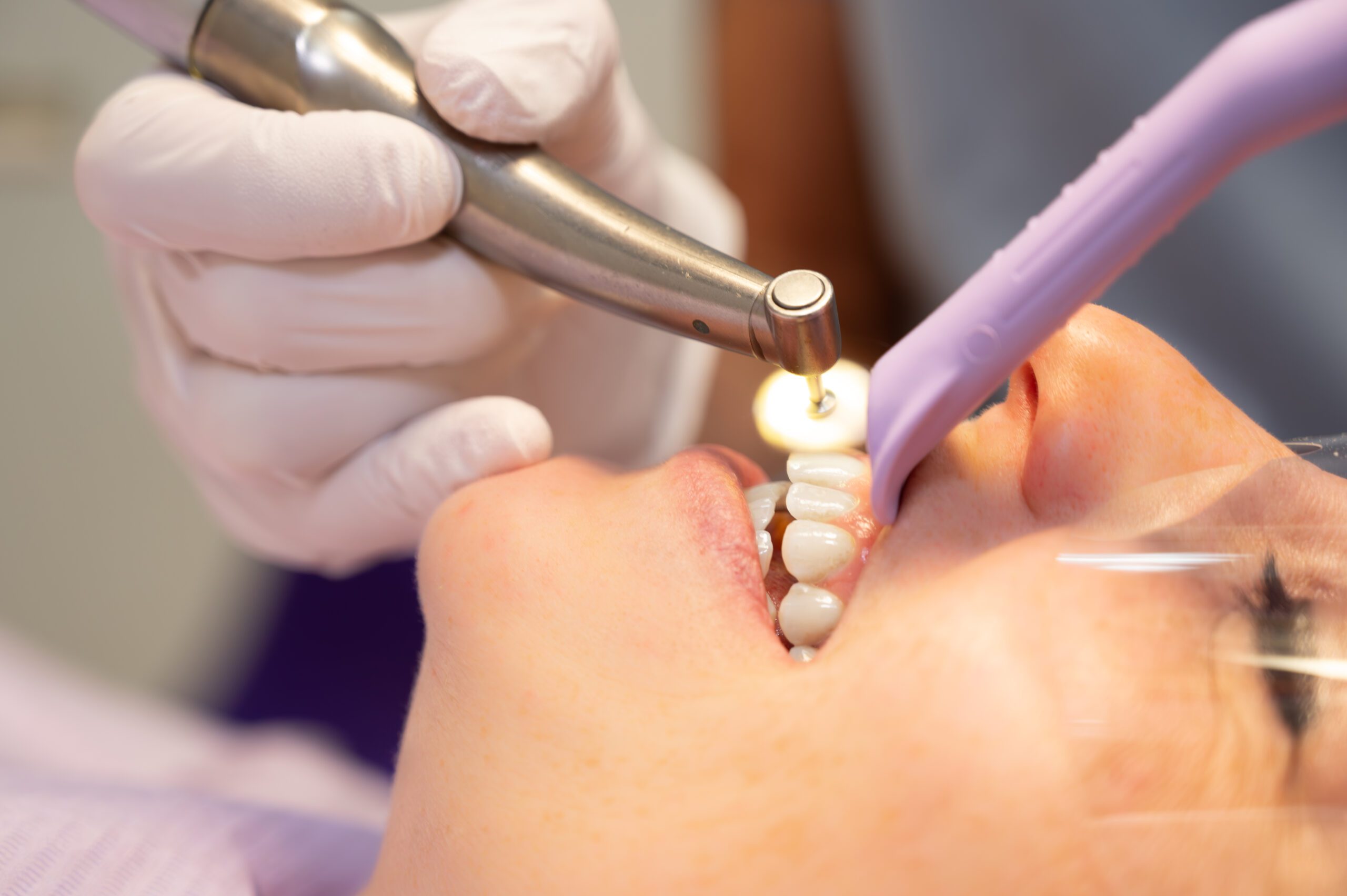 Facings | Tandarts Eline