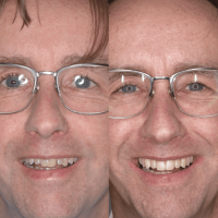 Aligners | Tandarts Eline