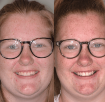 Aligners | Tandarts Eline