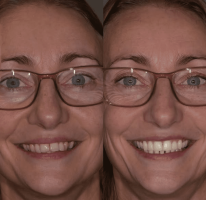 Aligners | Tandarts Eline