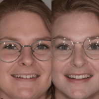 Aligners | Tandarts Eline