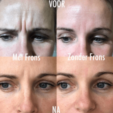 Botox | Tandarts Eline
