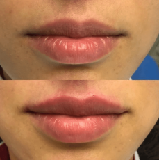 Fillers | Tandarts Eline